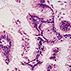 全エクソーム配列決定により明らかになった膵管内乳頭粘液性腫瘍における高頻度のGNAS変異
