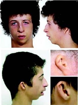 
Two individuals with classical Meier-Gorlin syndrome.
