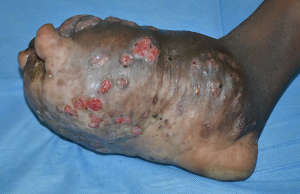 Mycetoma of the foot