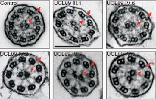 
Outer dynein arms in respiratory epithelial cell cilia from individuals with PCD carrying  DNAAF3  mutations are missing in the bottom row.
