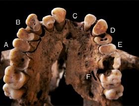 
عظم فكّ علوي في تافورالت يظهر عدة حالات لنخر الأسنان.
