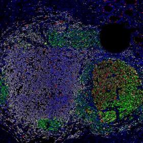 تلوين مناعي متألق ثلاثي لأورام القولون والمستقيم البشرية يوضح تكاثر الخلايا اللمفاوية ضمن الأورام.