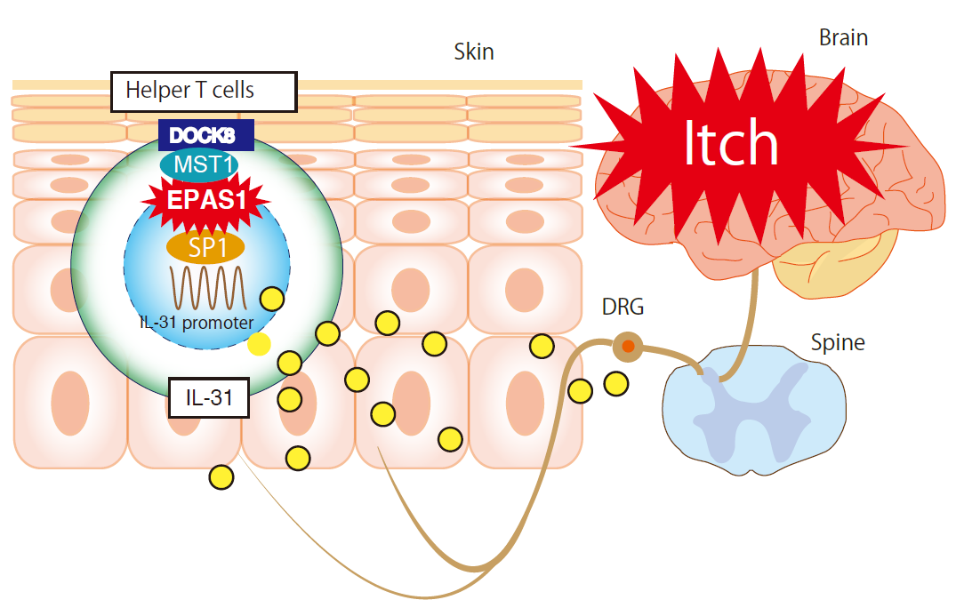 DOCK8欠損によるアトピー性の皮膚炎症には、転写因子EPAS1を介したIL-31の産生誘導が関与している