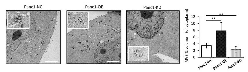 浸潤性膵管癌においてmicroRNA-155はエクソソーム合成を調整しゲムシタビン耐性を促進する
