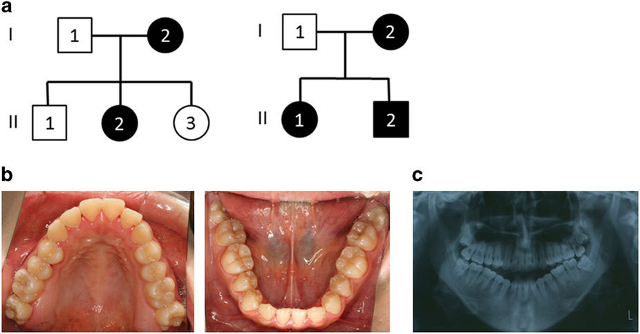 下顎前歯先天欠如についてのエキソーム塩基配列決定による包括的な遺伝学的調査