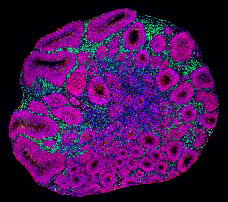 脳オルガノイドの顕微鏡画像。赤紫色はニューロン前駆細胞を、緑色は深層の投射ニューロンを示す。後者は、自閉症リスク遺伝子の変異によって影響を受ける細胞タイプの1つである。