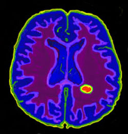 多発性硬化症患者の脳のFLAIR画像。赤く着色されたのが病変部。