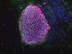 1型糖尿病患者由来の細胞から樹立した胚性幹細胞株のコロニー。緑色（Tra1-60）と赤色（nanog）はそれぞれ多能性幹細胞で発現するマーカーである。