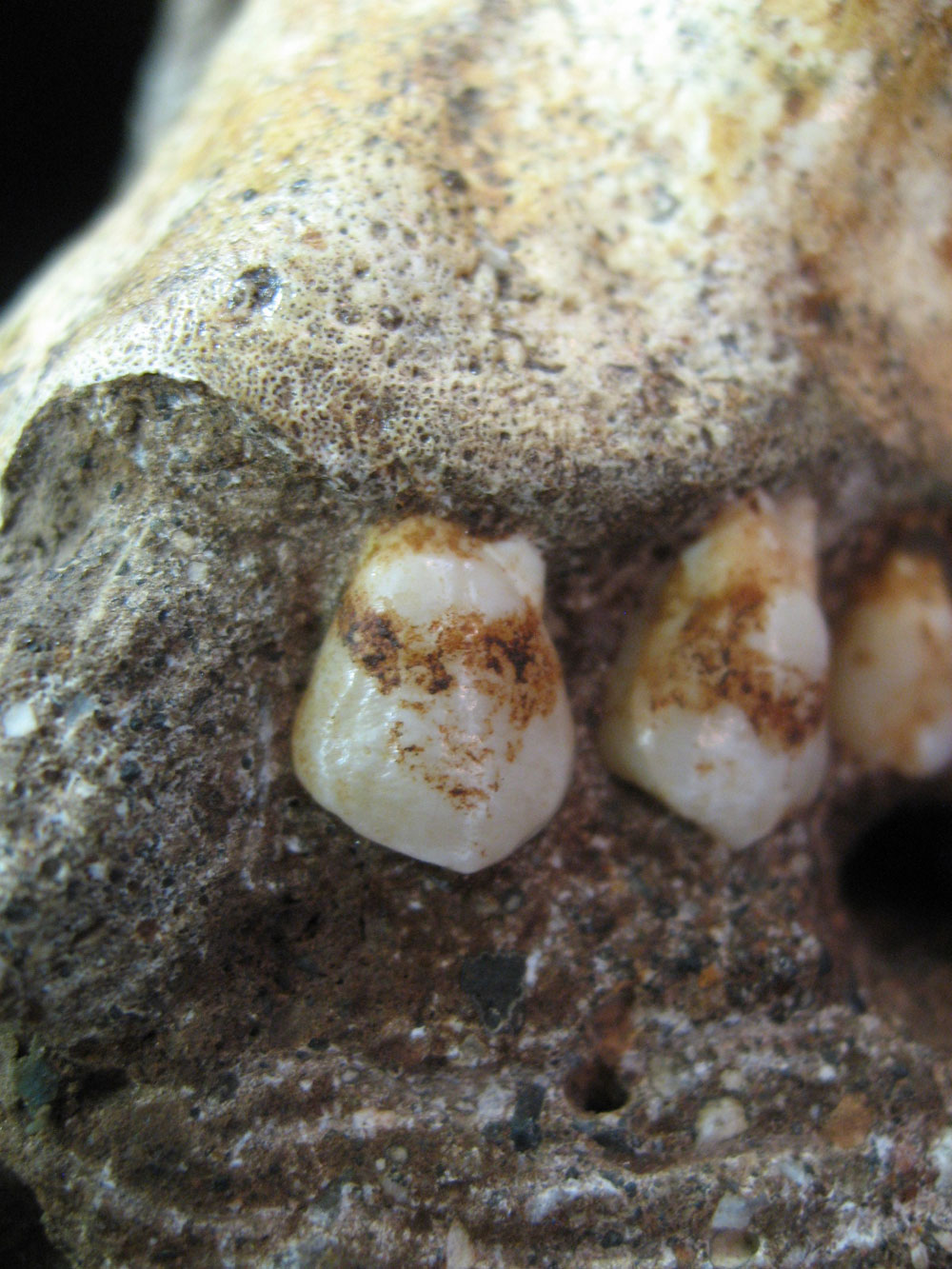 アウストラロピテクス・セディバの第一小臼歯に見られる歯石。