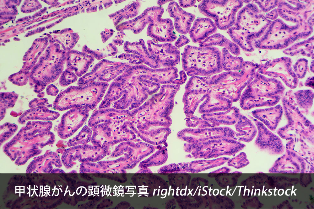 福島の若年層の甲状腺がんでは<i>BRAF<sup>V600E</sup></i>変異が高頻度である：チェルノブイリとは異なる発がんプロファイル