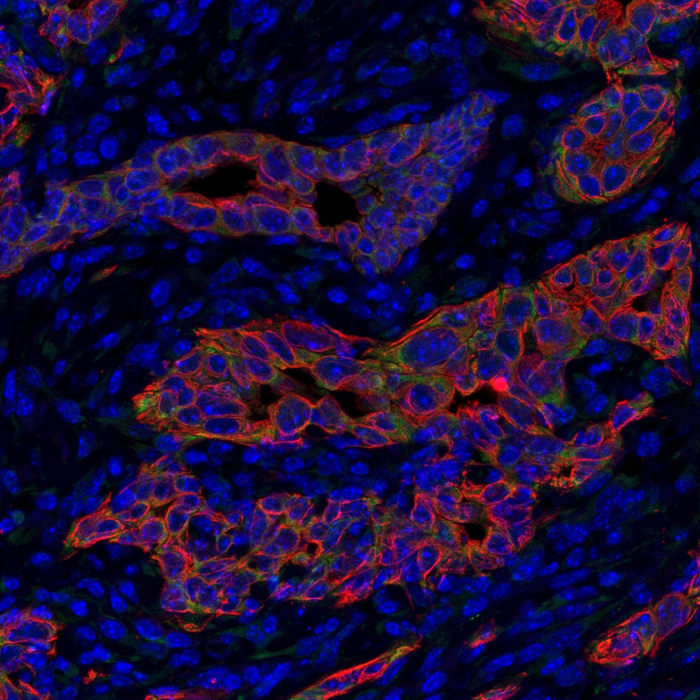 膵臓がん細胞（赤色）内で発現するMusashi（緑色）。