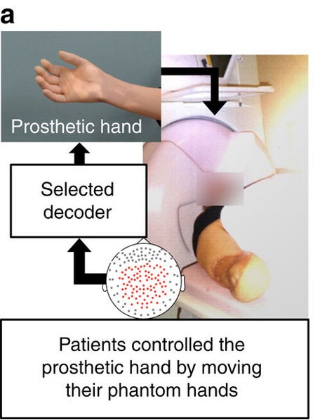 脳の感覚運動野における可塑性の誘導が幻肢患者の疼痛をコントロールする