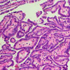 福島の若年層の甲状腺がんではBRAFV600E変異が高頻度である：チェルノブイリとは異なる発がんプロファイル