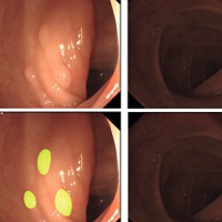 機械学習で結腸ポリープを発見する