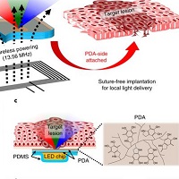 メトロノミック光線力学的がん治療に向けた組織接着性・無線給電式発光デバイス