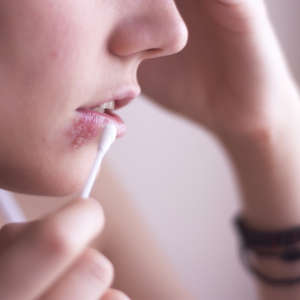 HSV-1 is most commonly known for the cold sores it causes around the mouth.