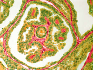 Light micrograph of a section through a papillary cancer of the thyroid gland.