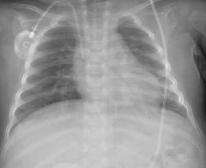 Chest radiography after two months of ruxolitinib therapy showed sufficient improvement for weaning off of mechanical ventilation.