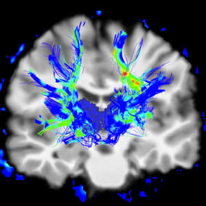 Parkinson’s disease is typically caused by protein aggregations in the brain, leading to the death of motor neurons, which are highlighted in blue/green here.