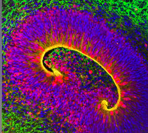 Brain organoids derived from a patient’s stem cells allowed researchers to understand how a mutation linked to neurodevelopmental problems affects organization of the brain. This organoid is labelled with multiple fluorescent markers for different neuron- and glial cell-specific proteins.