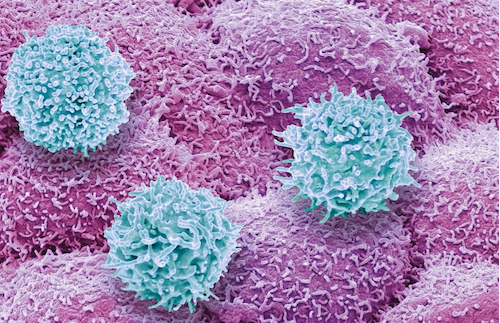 الخلايا التائية في جهاز المناعة (تظهر باللون الأزرق) تُهاجم خلايا سرطان البروستاتا (تظهر باللون الأرجواني).