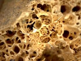 
A close-up of bone formation at 35x magnification located within the lytic focus.
