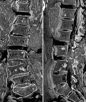 X-rays show sclerotic bone lesions in one of the mummies.