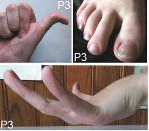 The three patients spanning a three generation family exhibited symptoms of connective tissue disorder resembling Ehlers-Danlos syndrome, including soft, velvety and mild hyperextensible skin, multiple small atrophic scars with delayed wound healing, generalized joint hypermobility, Raynaud-like syndrome, striae distensae (dermal scarring), repeated sprains of the ankles and wrists without trauma, and chronic widespread pain.