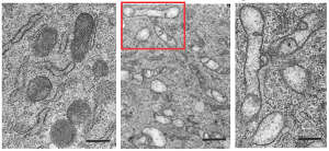 Microscopic images of control enamel cells (left) and enamel cells treated with high levels of fluoride (middle), with a close-up of mitochondria from the latter (right).