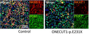 Wild-type human stem cells (left) can be coaxed to form fully functional pancreatic progenitors, as shown by expression of the marker genes PDX1 and NKX6.1. Diabetes-associated mutations in the ONECUT1 gene (right) result in greatly reduced numbers of such progenitors.
