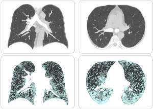 These images are from a COVID-19 survivor with severe post-COVID complications. The upper parts are visualizations by traditional methods: everything looks normal. The lower parts are DLPE enhanced, where healthy parts are black and lesions are white: many subvisual lesions are unveiled.