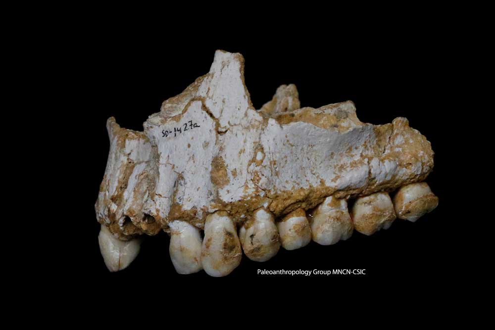 エル・シドロン（スペイン）で出土したネアンデルタール人の上顎の骨。画像右側の大臼歯に歯石の蓄積が見られる。この個体は、アスピリンの有効成分であるサリチル酸を含むポプラや、天然の抗生物質を含むアオカビなどが生えた植物を食べていたらしい。