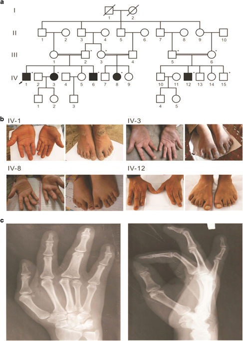 <i>BHLHA9</i>の新規ホモ接合性ミスセンス変異がパキスタンの1家系において指骨減少を伴う軸中骨癒合性合指症を引き起こす