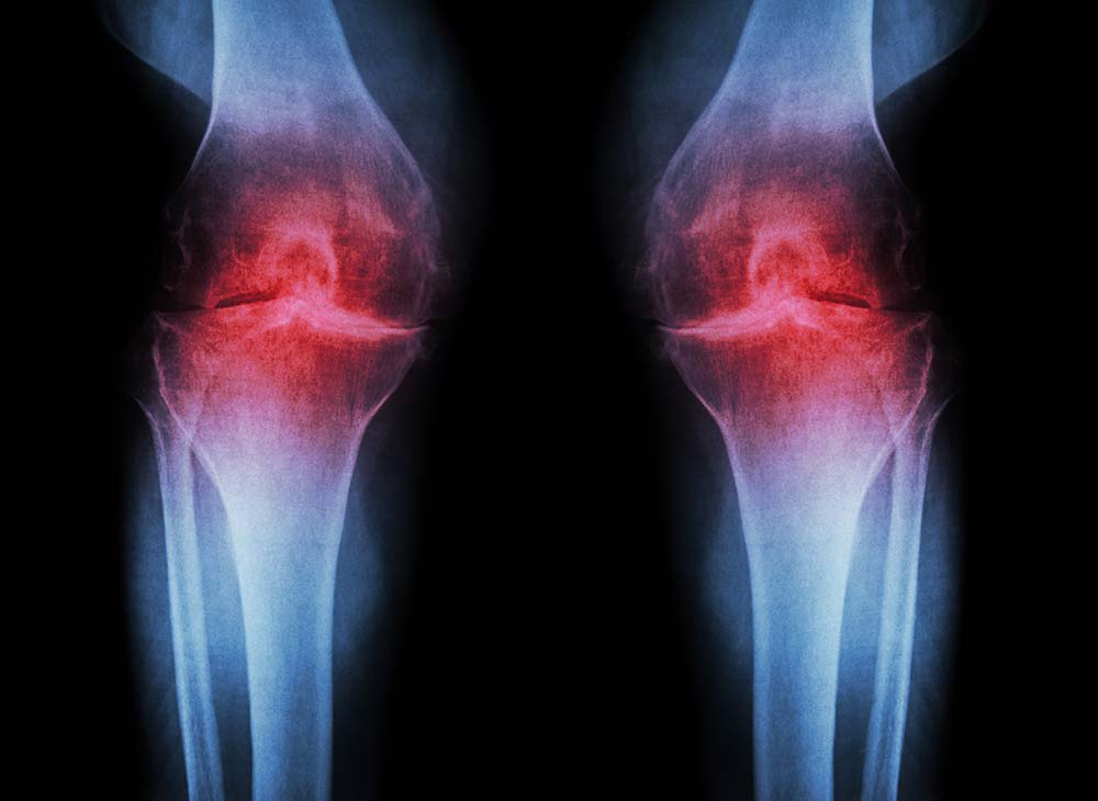  変形性関節症の患者の膝のX線画像。