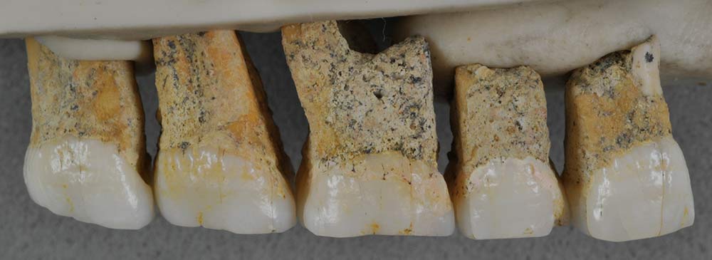 ホモ・ルゾネンシス（<i>Homo luzonensis</i>）の右上の歯（舌側から見た画像）。左から2本の小臼歯と3本の大臼歯が並ぶ。
