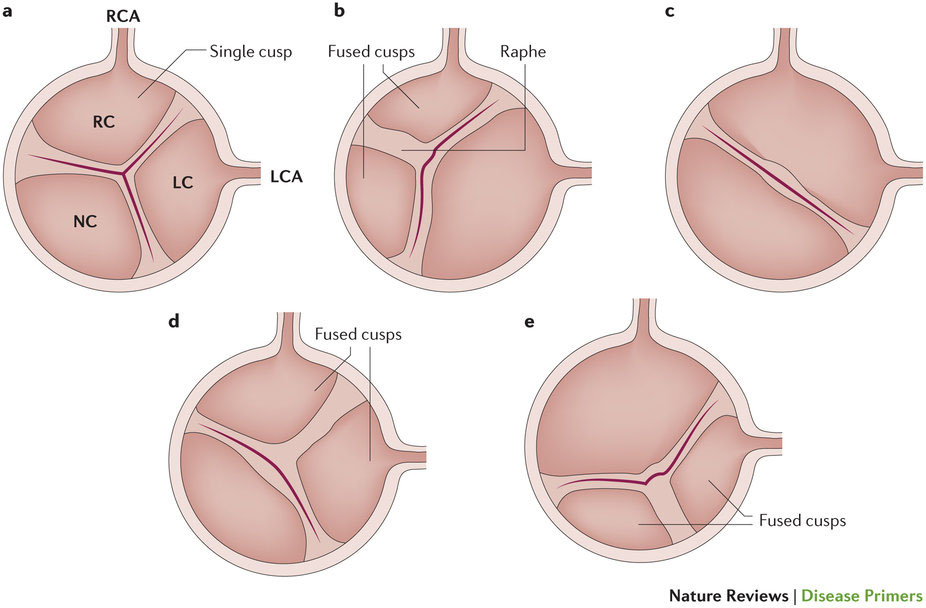 大動脈二尖弁の治療