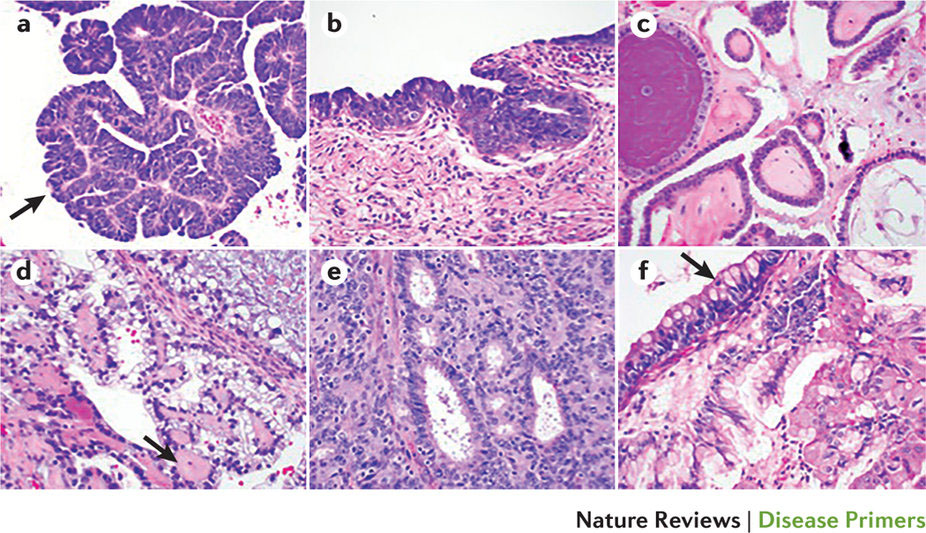 粘液性卵巣がんとは何ですか?