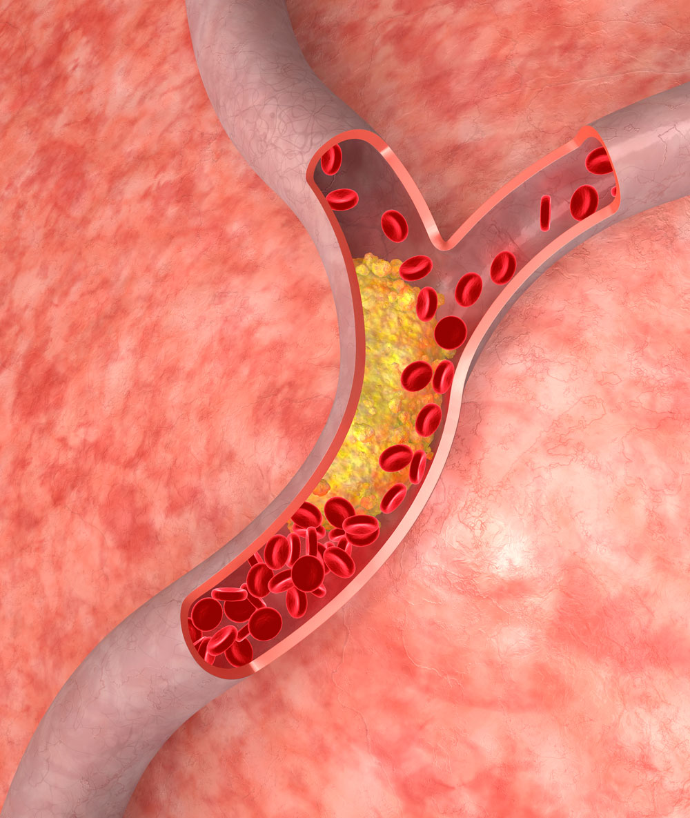 プラークが形成され血流が滞っている血管（イメージ画像）。