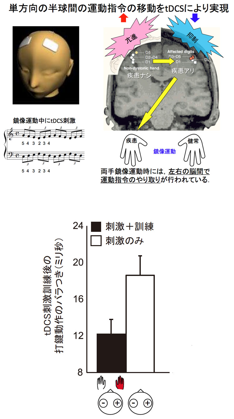 ジストニア 症状