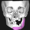 インクジェットプリンター技術による人工骨のカスタムメイド造形を実用化