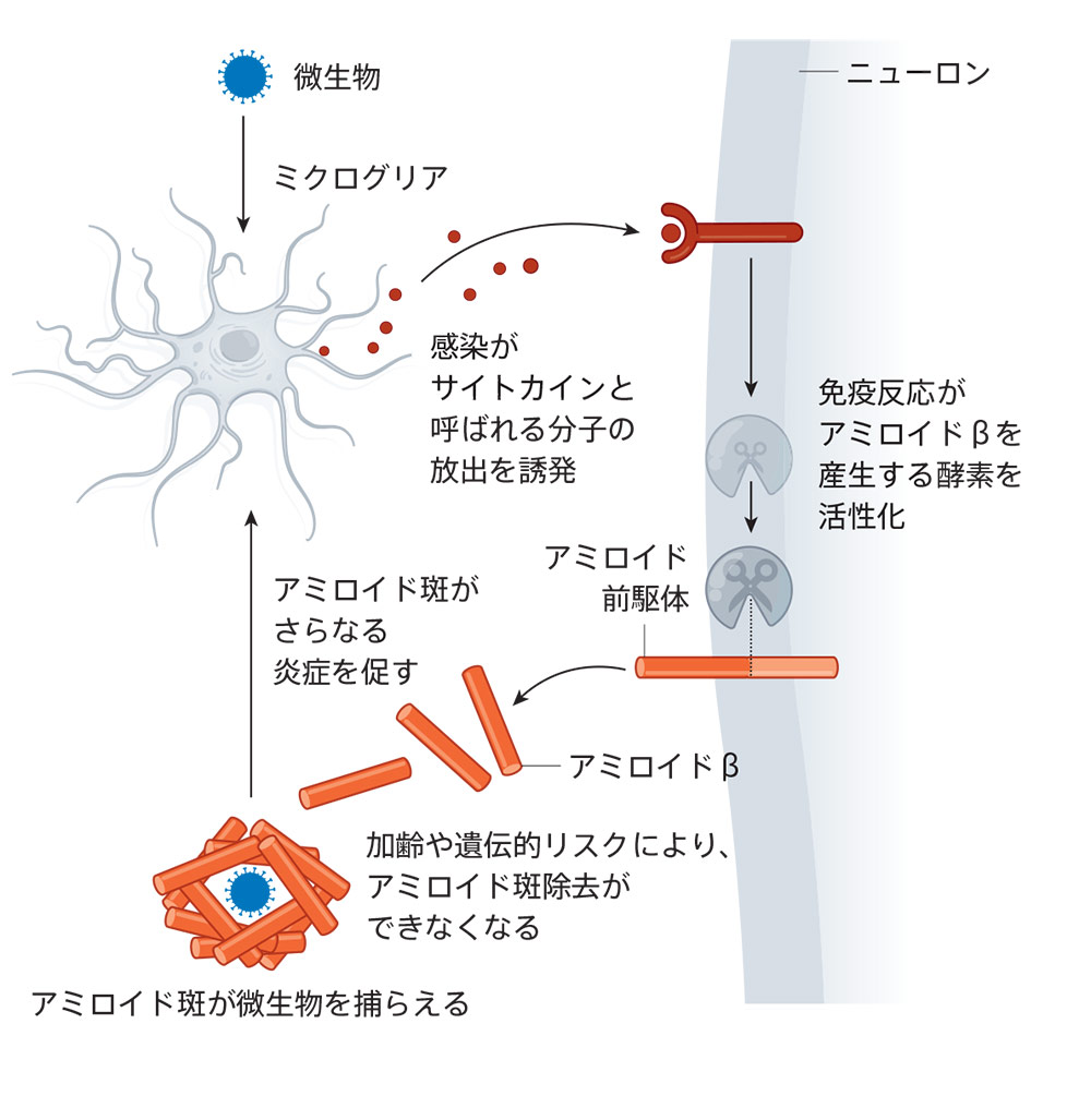 微生物感染がアルツハイマー病の引き金に？ | Nature