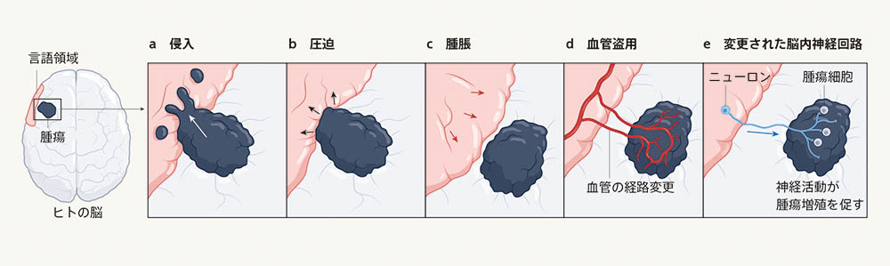 思考そのものが腫瘍増殖を促進する仕組み | Nature ダイジェスト